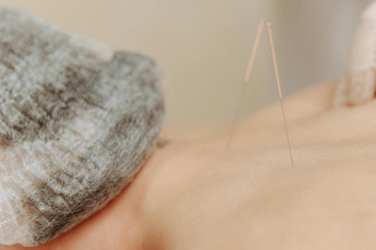 Benefits of Acupuncture